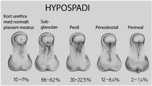 hipospadias penis)